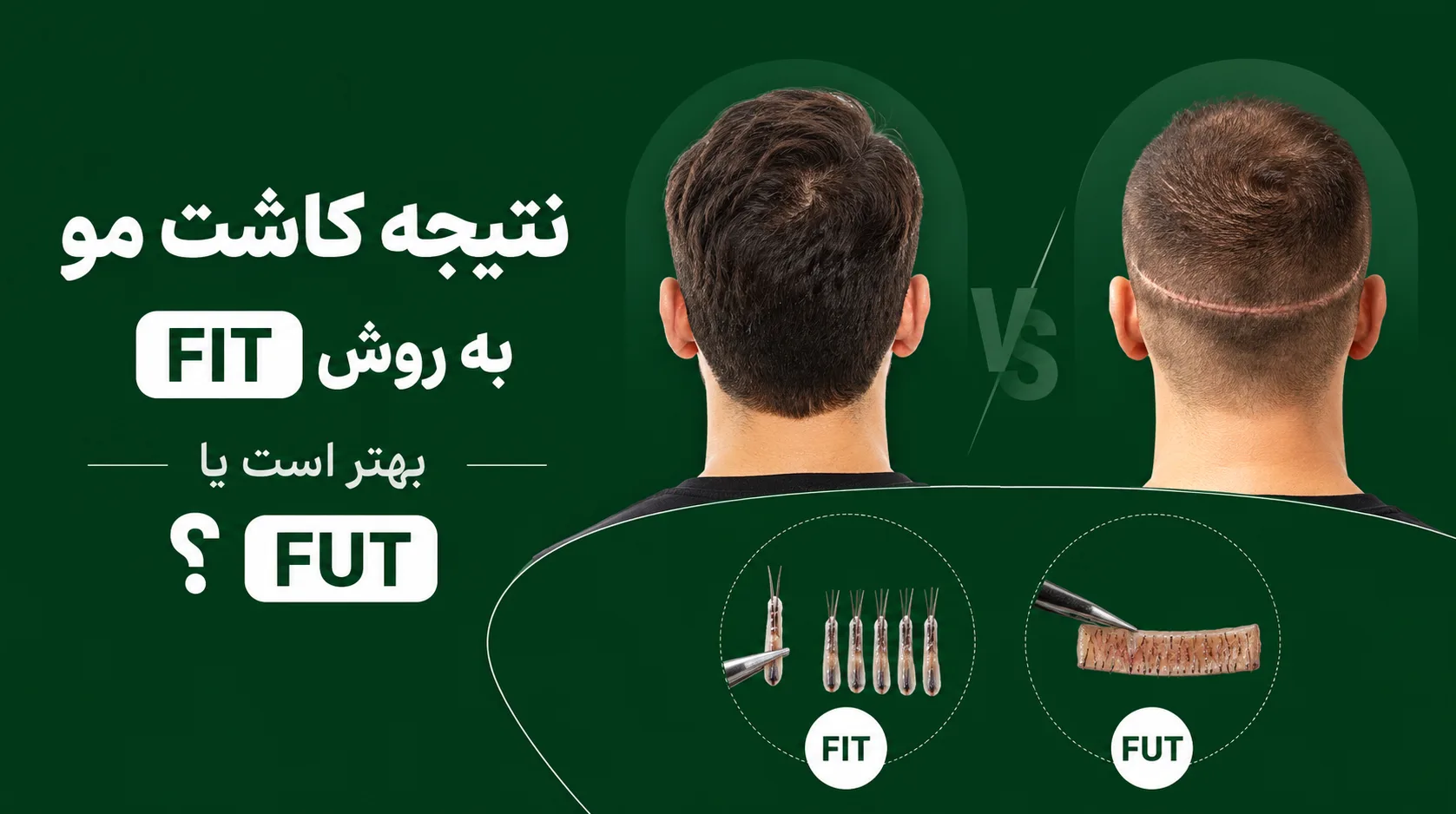 نتیجه کاشت مو به روش FIT بهتر است یا FUT؟